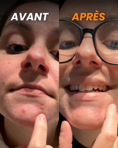 Brave Skin - Patches de jour et de nuit contre l'acné